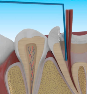 Endodoncia