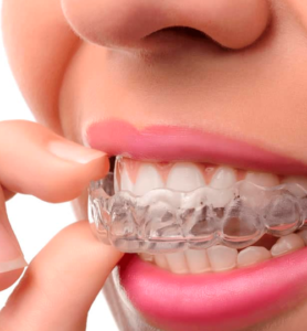Invisalign